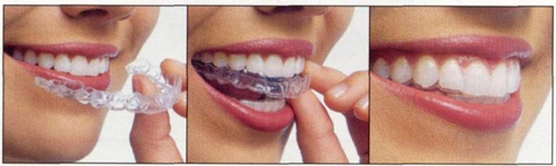 Kits Family Dental, Invisalign Kitsilano - Straigten Teeth With Clear  Braces
